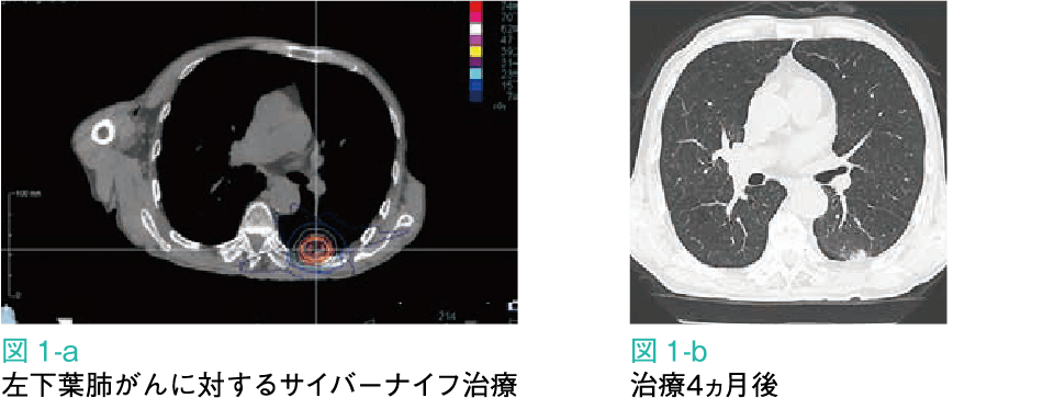 図1-a：左下葉肺がんに対するサイバーナイフ治療 図1-b：治療4ヵ月後