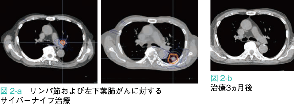 図2-a：リンパ節および左下葉肺がんに対するサイバーナイフ治療 図2-b：治療後