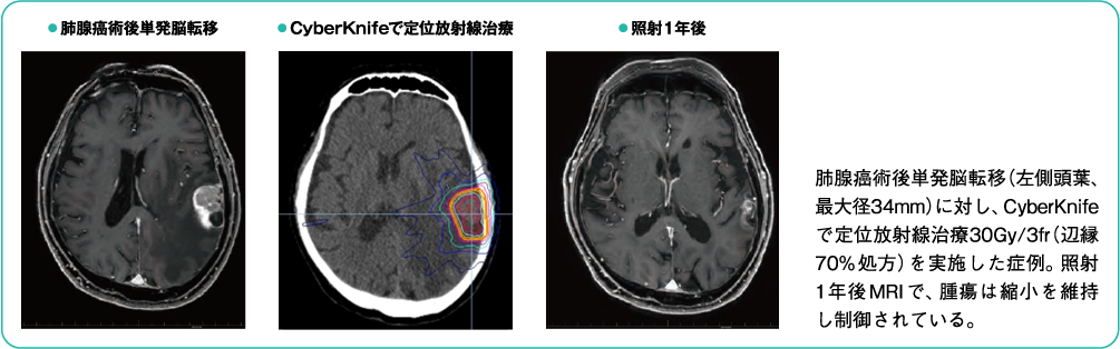 肺腺癌術後単発脳転移（左側頭葉、最大径34mm）に対し、CyberKnifeで定位放射線治療30Gy/3f（r 辺縁70% 処方）を実施した症例。照射1年後MRI で、腫瘍は縮小を維持し制御されている。