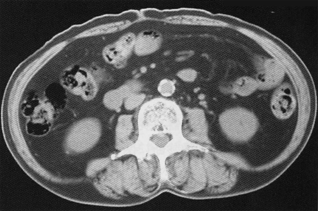 内臓脂肪が蓄積された腹部CT画像