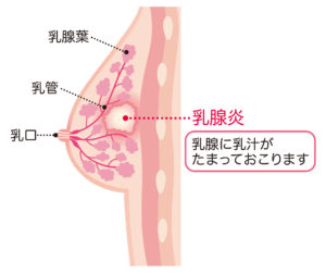 乳がんの検査と治療は必ず乳腺科へ 乳腺科と婦人科の違いは