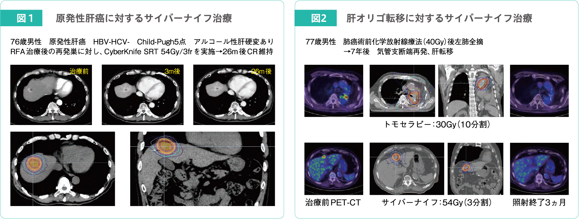 図1：肺原発性肝癌に対するサイバーナイフ治療 図2：肝オリゴ転移に対するサイバーナイフ治療