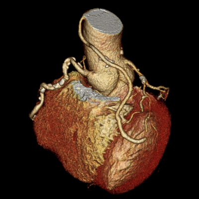 心血管の石灰化と狭窄