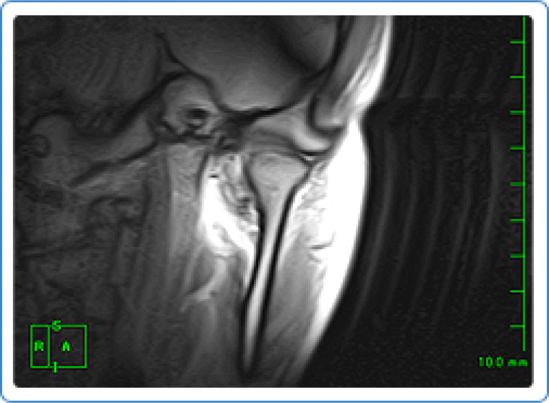 MRI検査例：極軽度の前方転移・最大開口位での亜脱臼