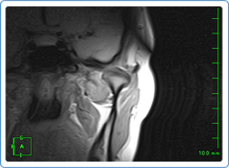 MRI検査例：両側顎関節関節円板の前方転移（復位あり）