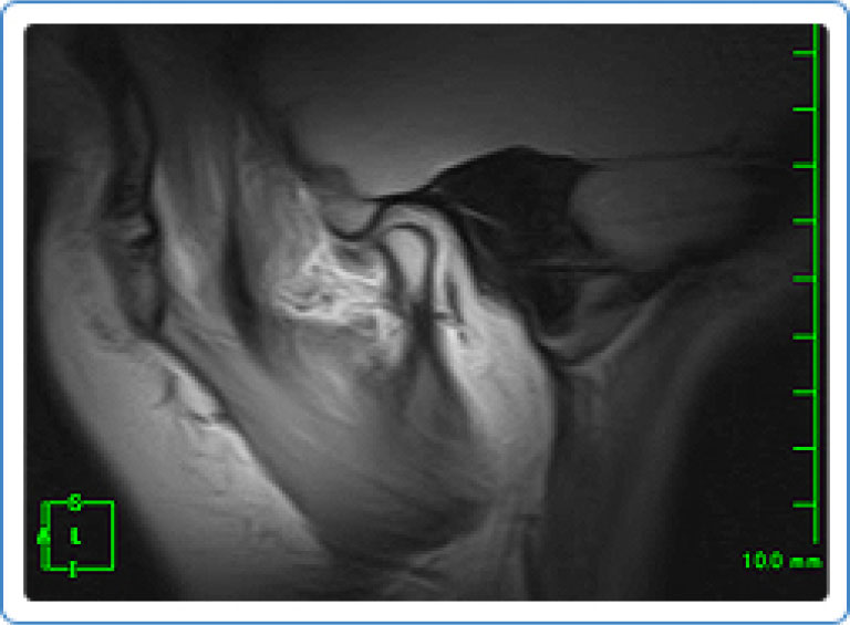 MRI検査例：両側顎関節関節円板の前方転移（復位あり）